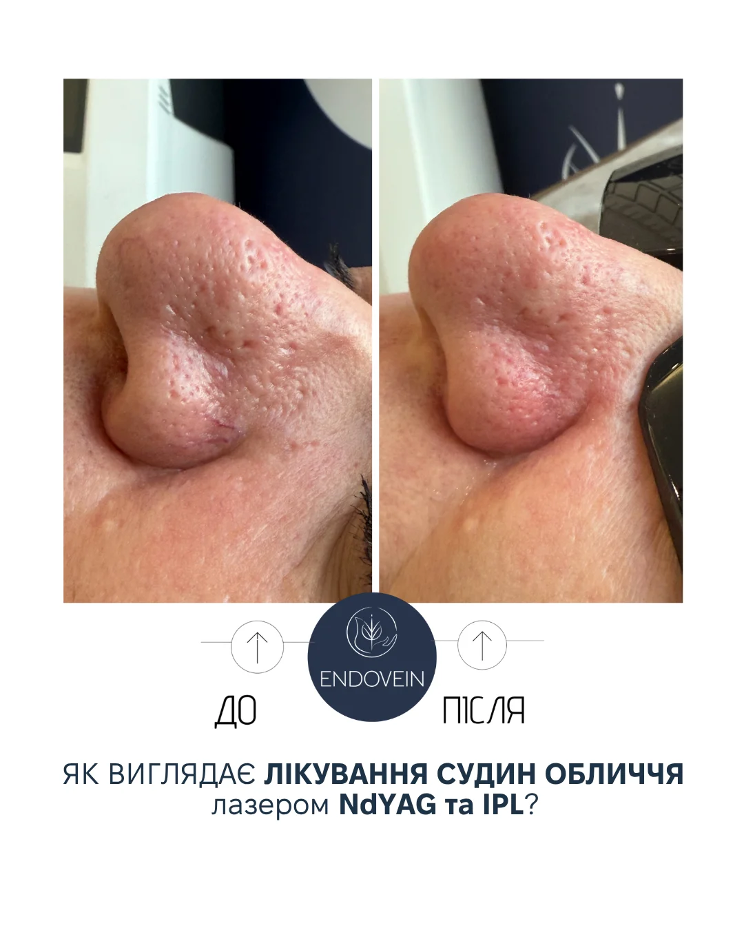 Лікування судин обличчя лазером Nd:YAG та IPL